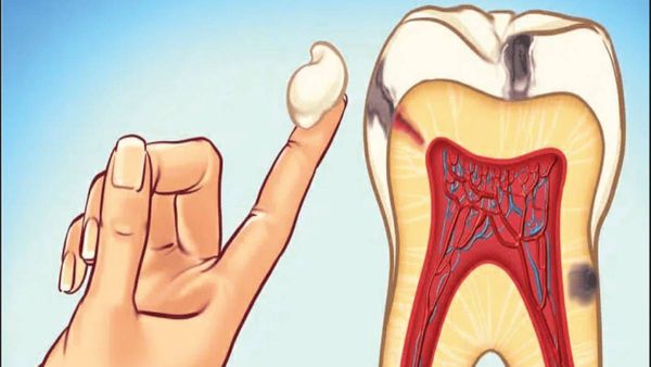 பல் வலி எதனால் வருகிறது?...பல் சொத்தையை சரி செய்வது எப்படி?