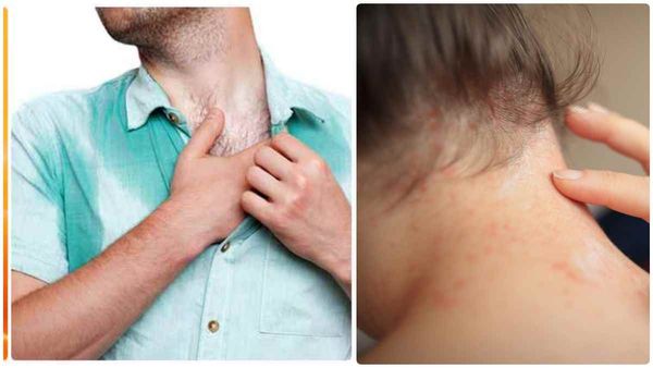 வெயில் காலத்தில் வியர்க்குருவால் அவதிப்படுகிறீர்களா? இதை மட்டும் பண்ணுங்க.. ஈஸியா தடுக்கலாம்