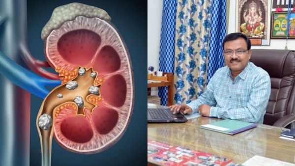 வெயில் காலத்தில் அவஸ்தைபடுத்தும் சிறுநீரக கற்கள்! ஆப்ரேஷன் செய்யாமல் கரைக்க என்ன வழி?