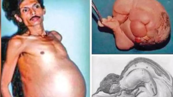 அரிதிலும் அரிது! 36 வருடமாக வயிற்றில் இரட்டை குழந்தைகளுடன் வாழ்ந்த ஆண்.. மருத்துவர்கள் சொல்வது என்ன?