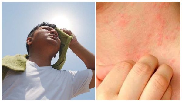 வியர்க்குரு உடலில் அதிகமாக வருகிறதா.. அதனை போக்க சூப்பர் வழிகள்.. ஆனால் ஒரு கண்டிசன்