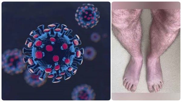 திடீர் திடீரென நீல நிறத்தில் மாறும் கால்கள்.. ஏன் இப்படி! கொரோனா ஏற்படுத்தும் கொடூரம்.. எச்சரிக்கை