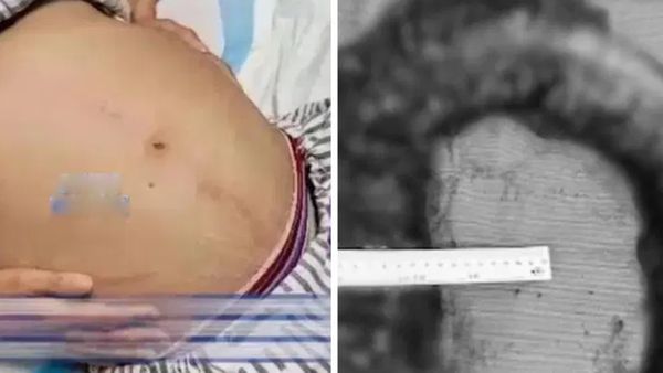 10 நாளாக மலம் கழிக்காத பெண்.. வயிற்றை கிழித்து 3 அடி நீள 20 கிலோ