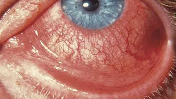 திறக்கவே முடியாத வலி! பச்சை கலர் நீர்! கர்நாடகாவில் 40,000 பேருக்கு பாதிப்பு! பிங்க் ஐ ஏன் ஆபத்தானது