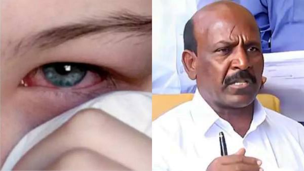 சென்னையில் பரவும் மெட்ராஸ் ஐ.. பள்ளி மாணவர்களுக்கு கண் பரிசோதனை.. மா.சுப்ரமணியன் உத்தரவு