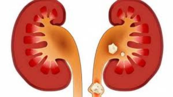 கிட்னியில் கற்களை கரைக்க இது ஒன்னு மட்டுமே போதும்.. ஆச்சரியமூட்டும் 