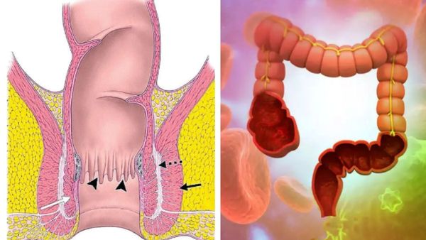 ஆசனவாய் அரிப்பா.. கவலையை விடுங்க.. உருளைக்கிழங்கு போதுமே..ஆசனவாய் எரிச்சலை தணிக்கும் சூப்பர் டிப்ஸ்