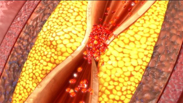 கொலஸ்ட்ரால் ஓவரா இருக்குதா? அப்ப இதை மட்டும் சாப்பிடுங்க.. இதய நோயை விரட்டும் அருமையான டிப்ஸ்