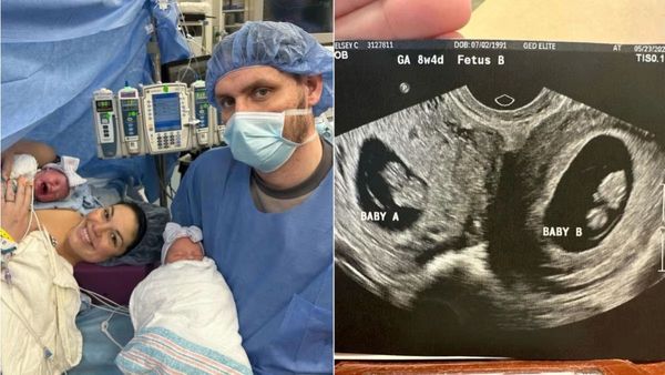 அரிதிலும் அரிது.. வினோத ட்வின்ஸ் இவுங்கதான்.. இரண்டு கர்ப்ப பைகள் கொண்ட பெண்ணுக்கு இரட்டை குழந்தைகள்