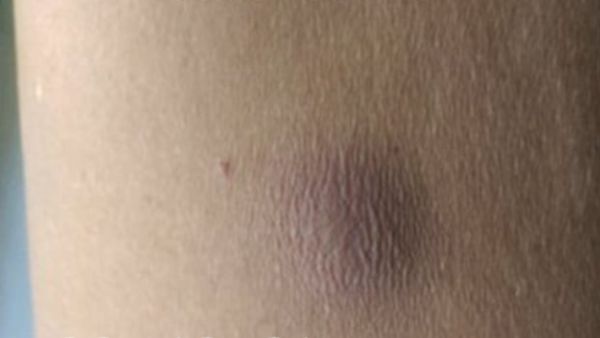 சேற்றுப்புண் அல்ல.. கருப்பு பூஞ்சையை விட மோசமான பாக்டீரியா.. கொஞ்சம் ஏமாந்தால் கூட ஆளே காலிதான்!