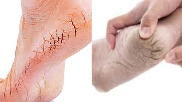 செதில் செதிலா வெடிப்பு.. ஈஸியா பாத வெடிப்புகளை விரட்டும் ஒரே பொருள்.. அழகான பாதம் வேணுமா? இதோ டிப்ஸ்