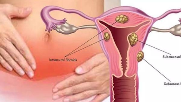 புற்றுநோய்.. கர்ப்பப்பை வாய் புற்றுநோய்.. பெண் குழந்தைக்கு இலவச தடுப்பூசி தேவை.. டாக்டர்கள் கோரிக்கை