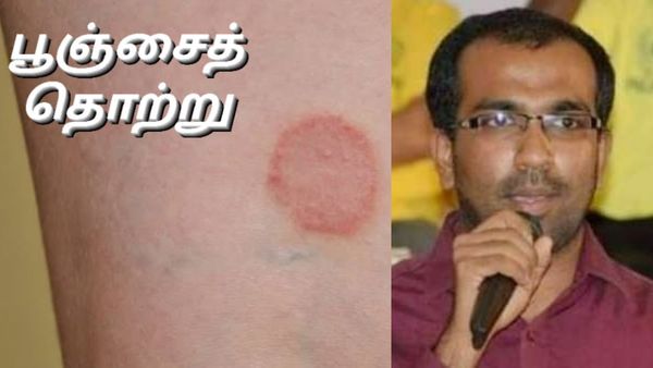 தொடை பகுதிகளில் அரிப்பு இருக்கிறதா? அது படர்தாமரைதான்! ஸ்டீராய்டு ஆயின்மென்ட் பூசிட போறீங்க! 