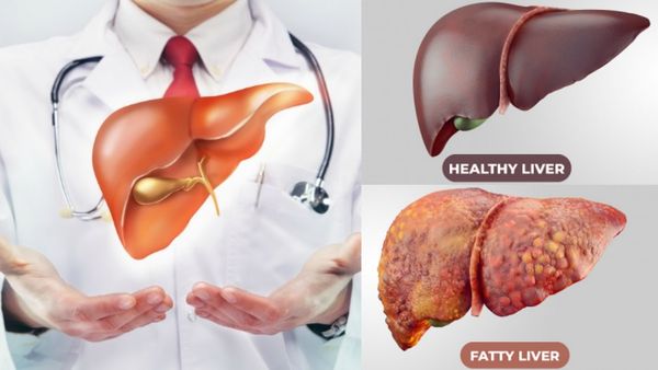 10 வருஷத்தில் கேன்சராக மாறும் Fatty liver.. கல்லீரலை பாதுகாக்கும் அந்த 4 விஷயங்கள்! டாக்டர் விளக்கம்