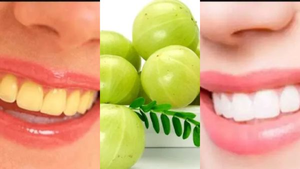 கிடுகிடுன்னு பல் ஆடுதா? நெல்லிக்காய் ஒன்று போதுமே.. ஆடும் பற்களை இரும்பாக்கும்.. சூப்பர் டிப்ஸ்கள்