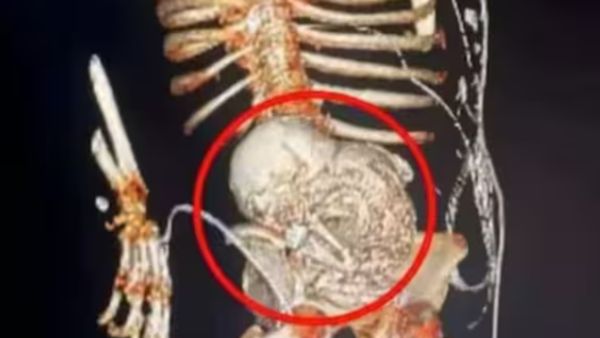 56 வருடமாக வயிற்றில் கருவை சுமந்த பெண்.. எக்ஸ்ரேவில் காத்திருந்த ஷாக்! மருத்துவ உலகில் வினோத சம்பவம்