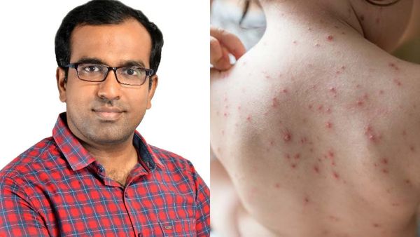 பேருதான் சின்னம்மை.. லேசில் விட்டால் மூளையை பாதிக்கும்! இது சிக்கன் பாக்ஸ் காலம்! உஷார்!