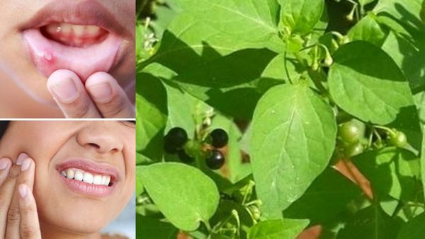 வாய்ப்புண்ணுக்கு பெஸ்ட் டிப்ஸ்கள்.. கோவக்காய் போதுமே.. வாய் புண்களை ஆற்றும் சூப்பர் இலைகள்.. அருமை