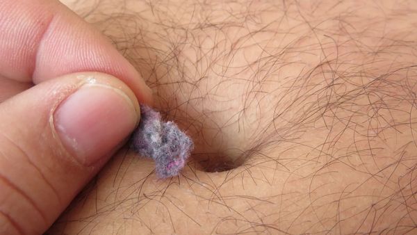 உங்கள் தொப்புளில் பஞ்சு பஞ்சாக உருளையாக அழுக்கு வெளியேறுகிறதா? என்ன காரணம்?