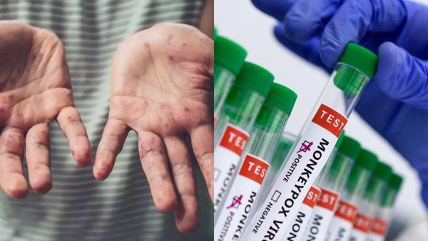 அடுத்த பெருந்தொற்றாக வெடிக்கும் மங்கி பாக்ஸ்? 