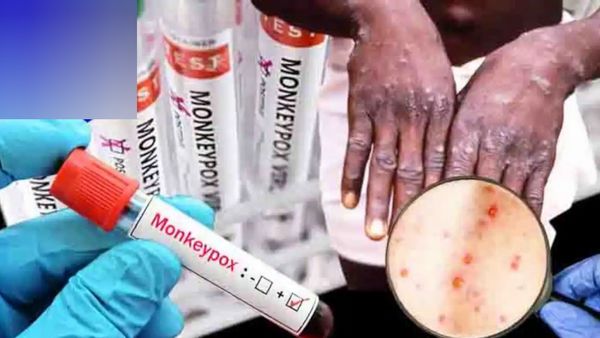 உயிரை கொல்லும் குரங்கு அம்மை.. தமிழகத்தில் பாதிப்பு இல்லை! பொது சுகாதாரத்துறை அறிவிப்பு