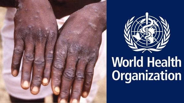 மீண்டும் மிரட்டும் மங்கிபாக்ஸ்.. சர்வதேச சுகாதார அவசர நிலையை அறிவித்தது WHO