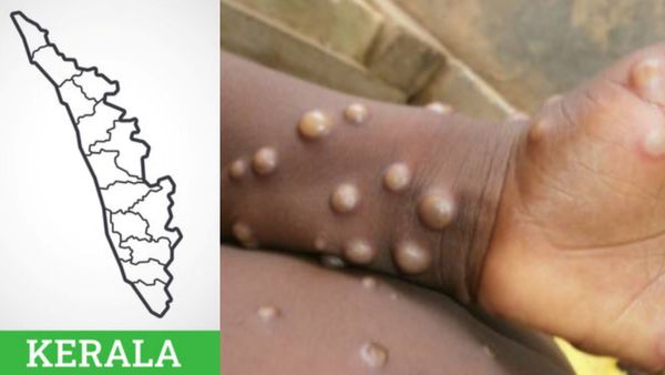 கேரளத்தில் பரவும் குரங்கு அம்மை.. இரண்டாவது நபருக்கு தொற்று உறுதி.. தீவிர கண்காணிப்பு