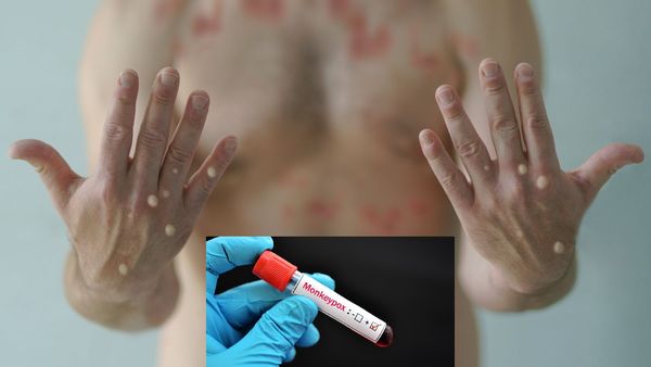 இந்தியாவில் கால் பதித்த குரங்கு அம்மை! அறிகுறிகள் என்ன? முன்னெச்சரிக்கை நடவடிக்கைகள் என்ன?