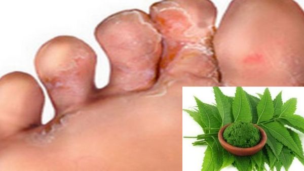 சேற்றுப் புண்ணுக்கு சரியான மருந்து இதுவே.. வெற்றி தரும் வேப்பிலை.. சேற்றுப்புண்களுக்கு சிறந்த மூலிகை