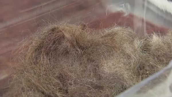 பெண் வயிற்றில் 2 கிலோ முடி.. குடும்பத்துக்கே தெரியாத ரகசியம்.. அதிர்ந்த மருத்துவர்கள்