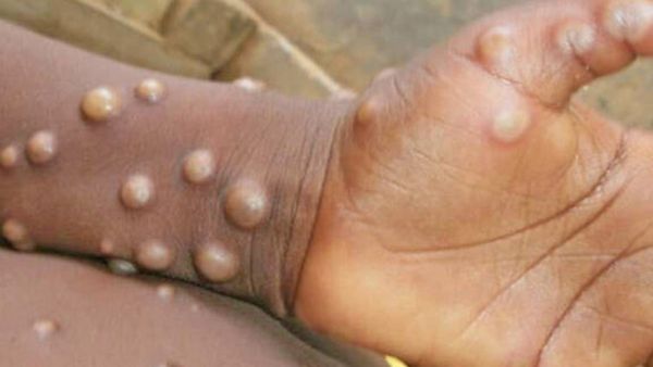 திருச்சி வந்த சார்ஜா விமான பயணிக்கு குரங்கம்மை அறிகுறி.. அரசு மருத்துவமனையில் அனுமதித்து சிகிச்சை..!