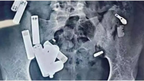 பிளேடு, பேட்டரி, ஸ்க்ரூ.. சிறுவனின் வயிற்றுக்குள் 65 பொருட்கள்.. ஆபரேஷனுக்குப் பிறகு நேர்ந்த கொடூரம்