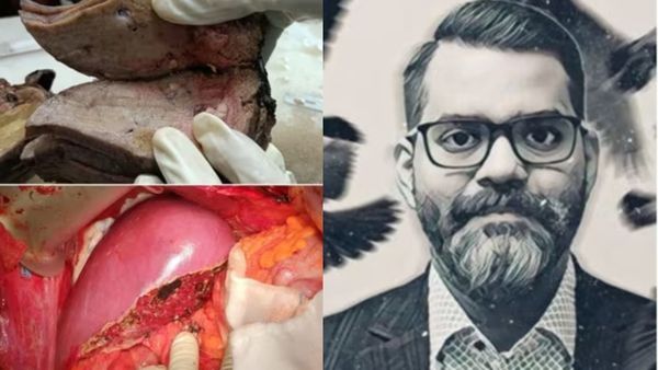 கல்லீரல் கல்லா போயிரும்லே.. வேணாம் குடிக்காதீங்கலே! டாக்டர் நேரடியாக காட்டிய டெமோ.. ஷாக் போட்டோ!