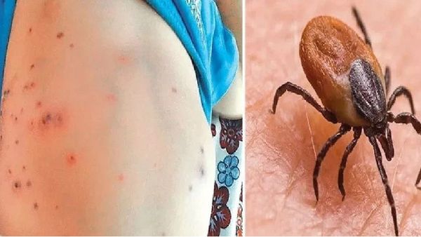 வேகமாக பரவும் 'ஸ்க்ரப் டைபஸ்' தொற்று.. யாருக்கெல்லாம் பாதிப்பு? இதை செய்தால் தப்பிக்கலாம்!