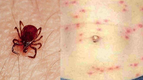 வேலூர் பக்கம் அச்சுறுத்தும் ஸ்க்ரப் டைஃபஸ் பாதிப்பு! ஒருவரிடமிருந்து மற்றொருவருக்கு பரவுமா? விளக்கம்