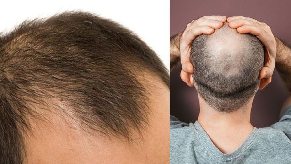 ஆண்களிடையே 