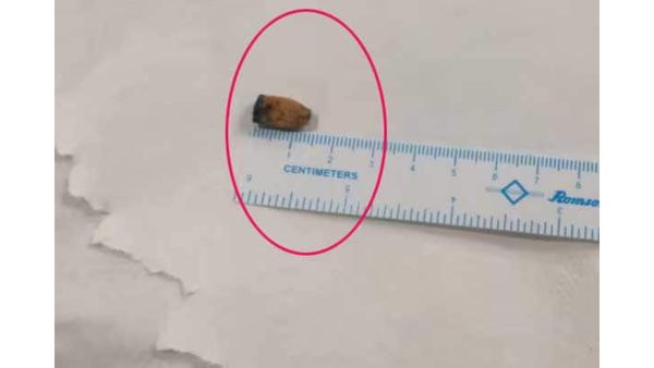 21 ஆண்டுகளாக நுரையீரலில் 