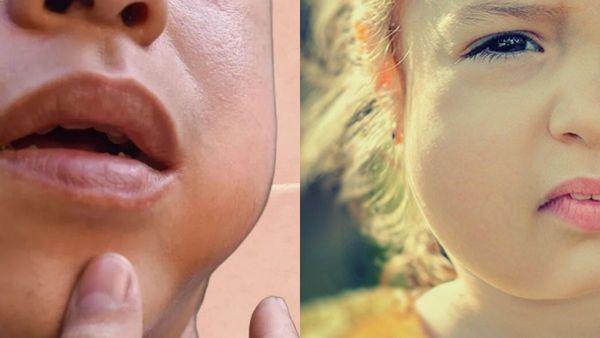 குழந்தைகளை அச்சுறுத்தும் பொன்னுக்கு வீங்கி நோய்! அறிகுறிகள் என்ன? டாக்டர் விளக்கம்