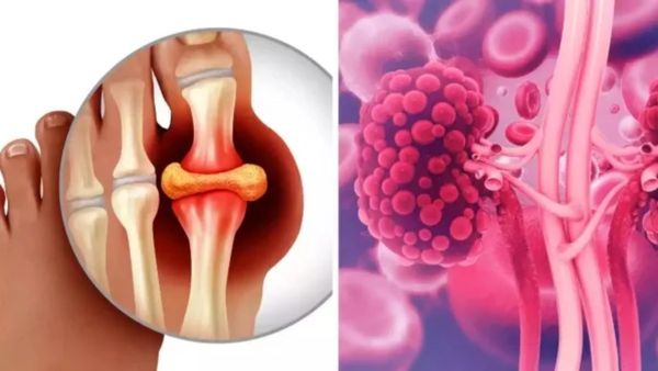 யூரிக் ஆசிட் லெவல் குறைக்கும் திரிபலா சூரணம்.. ஆரோக்கிய கொத்தமல்லி.. சர்னு யூரிக் அமிலம் இறங்கிடும்