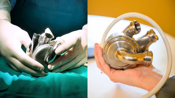 செயற்கை இதயத்துடன் 100 நாட்களுக்கும் மேல் வாழ்ந்த நோயாளி! சாதனை படைத்த மருத்துவர்கள்