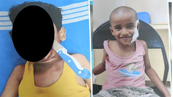 சறுக்கிய பாய்.. கன்னத்தில் இறங்கிய கத்தி! சபாஷ் சேலம் மருத்துவர்களுக்கு! பெற்றோர்களே ரொம்ப கவனம்!