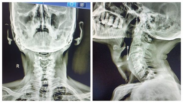 தொண்டைக்குள் சிக்கிய 