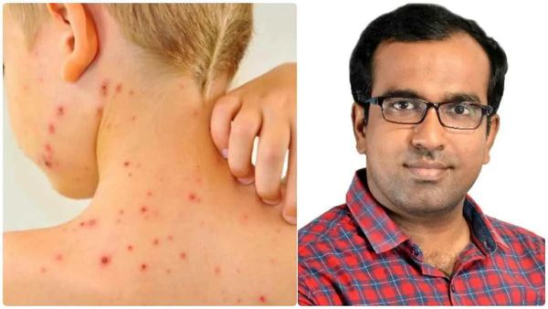 பேருதான் சின்னம்மை! இருமினாலும் தும்மினாலும் படார்னு பரவும்! அறிகுறிகள் என்னென்ன தெரியுமா?