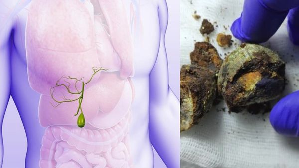 Gallbladder: பித்தப்பையில் கற்கள் ஏன் ஏற்படுகிறது? புற்றுநோய் வராது! ஆனால் வந்தால் டேஞ்சர்?