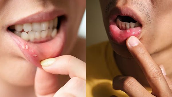 Mouth Ulcer: வாய்ப்புண்ணால் அவதிப்படுகிறீர்களா? வீட்டில் உள்ள பொருட்களை வைத்தே தீர்வு காண்பது எப்படி?
