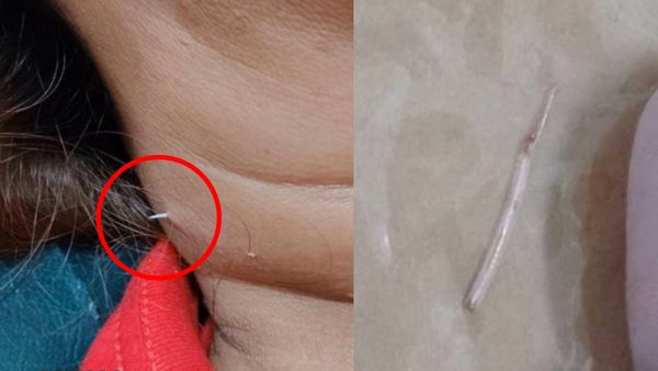 சூப் குடித்தபோது விபரீதம்.. தொண்டையில் சிக்கிய மீன் முள் கழுத்தை கிழித்து தோளுக்கு மேல் வந்தது