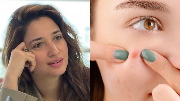 காலையில் பல் துலக்காமல் எச்சிலை எடுத்து முகப்பருக்களுக்கு வைக்கலாமா? தமன்னா சொல்வது சரியா?