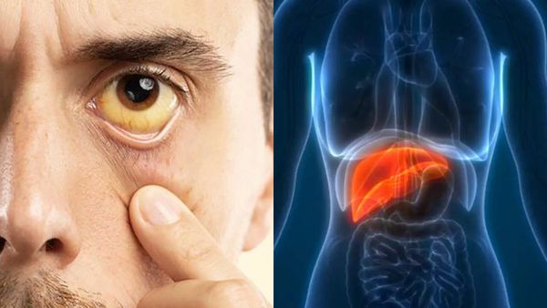 ரோபோ சங்கருக்கு என்ன ஆச்சு? மஞ்சள் காமாலை வந்தாலே கல்லீரல் பிரச்சினைதானா? மருத்துவர் விளக்கம்