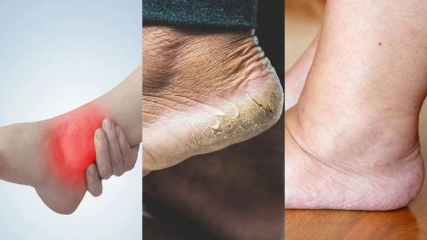 கணுக்கால் வீக்கம், வீங்கிய கால், பாத வெடிப்பை போக்க சூப்பர் ஹெல்த் டிப்ஸ்.. முட்டைகோஸ் இலை பேண்டேஜ்.