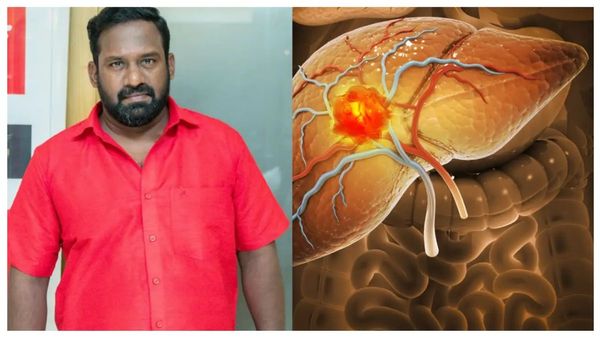 அலுமினிய பெயிண்ட்? ரோபோ சங்கரை காலி செய்த கல்லீரல்! லிவர் பாதிப்புக்கான காரணங்களை சொல்கிறார் Dr.ராதா